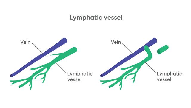 Lymphedema diagram