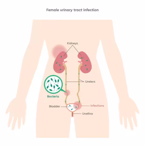 Illustration of a female urinary tract infection